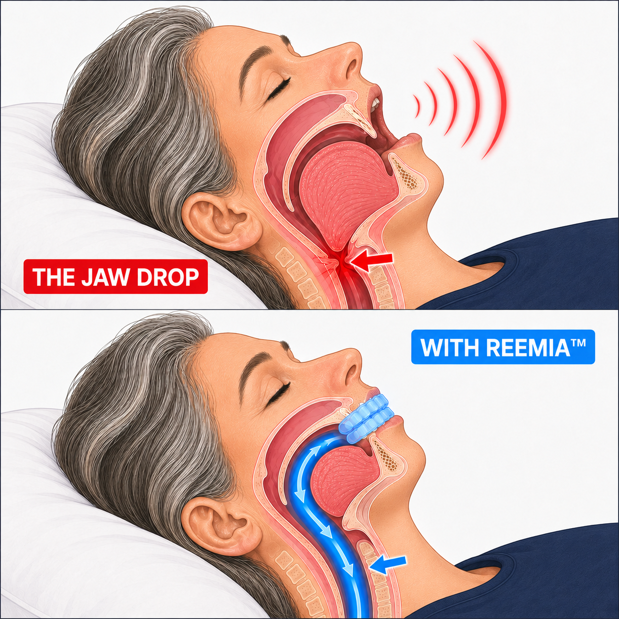Reemia™ Anti-Snoring Mouthpiece for Women